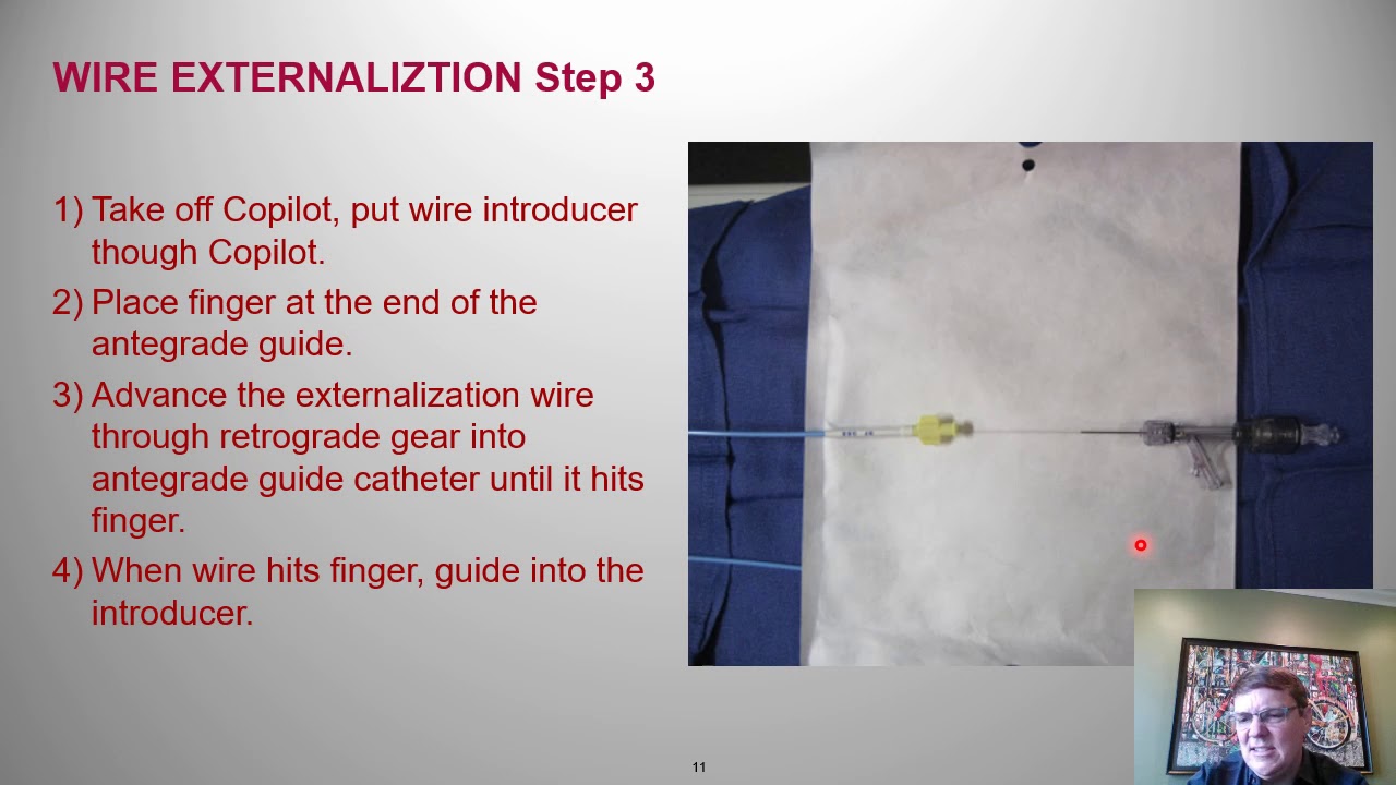 Guidewire externalization: Step-by-step - Tony Doing, MD