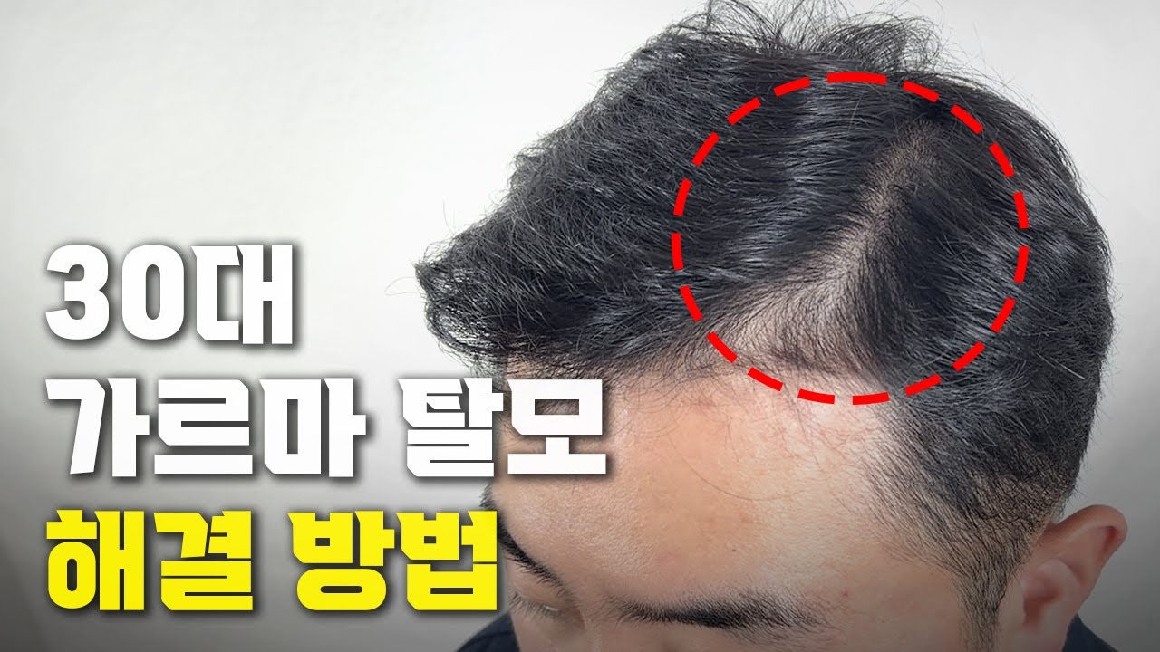 30대 가르마 탈모 두피문신+포마드 스타일링으로 해결 (정수리탈모/가르마탈모/사이드탈모)