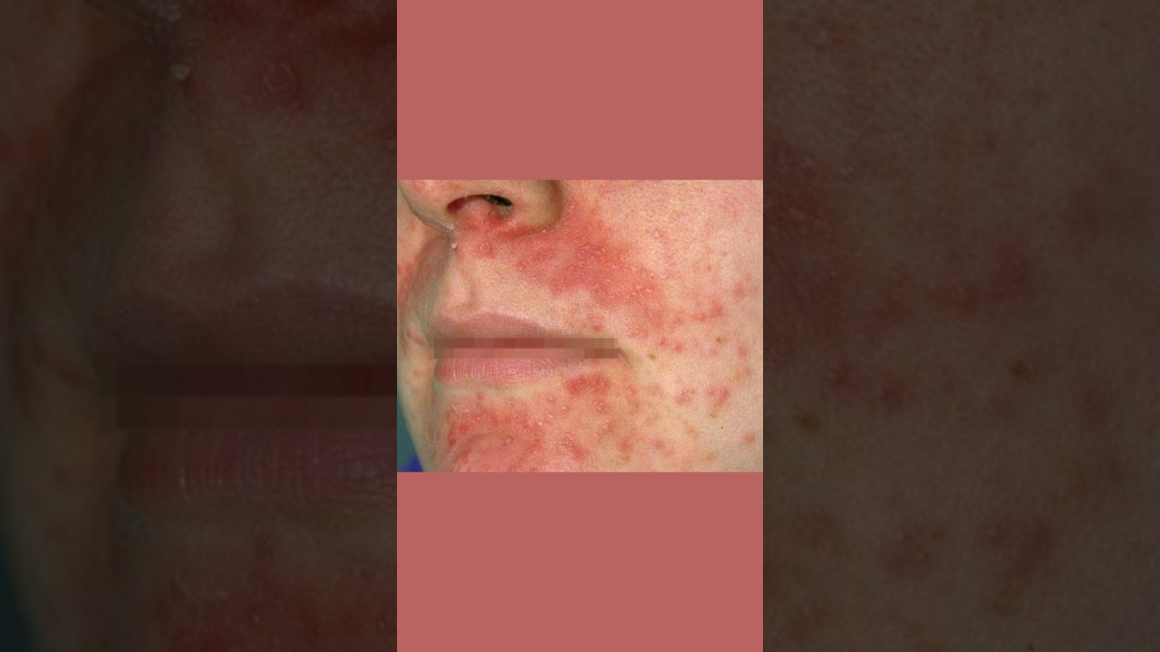 Why Your Perioral Dermatitis Won&rsquo;t Heal #dermatologist