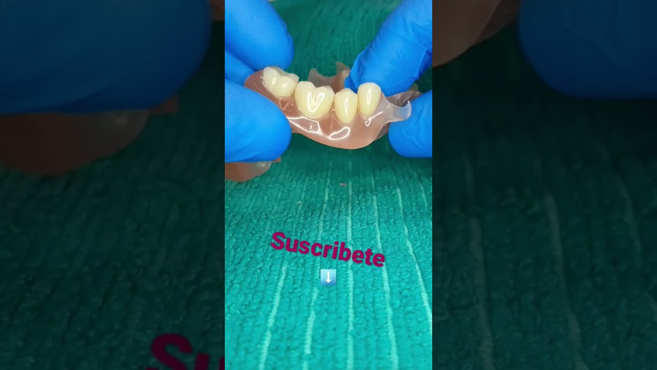protesis flexible #odontologia #shorts #mexico #colombia #dentist