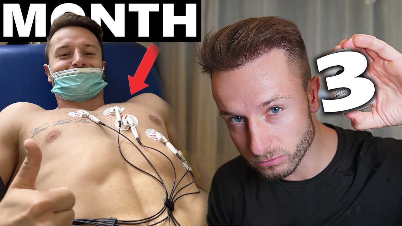 Обновление данных за 3 месяца приема миноксидила внутрь, ЭКГ, динамика роста волос, побочные эффе...