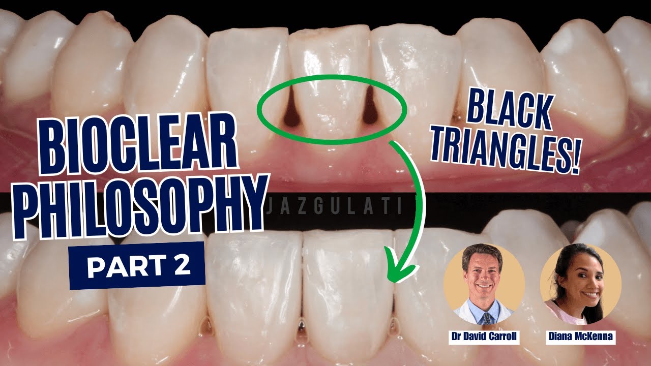 The Bioclear Philosophy of Adhesive Dentistry - Part 2 (Anterior) - PDP179