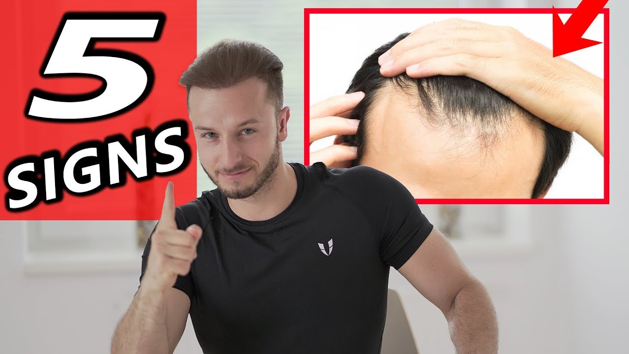 5 Ранние признаки облысения + 3 Советы для предотвращения этого СЕЙЧАС!
