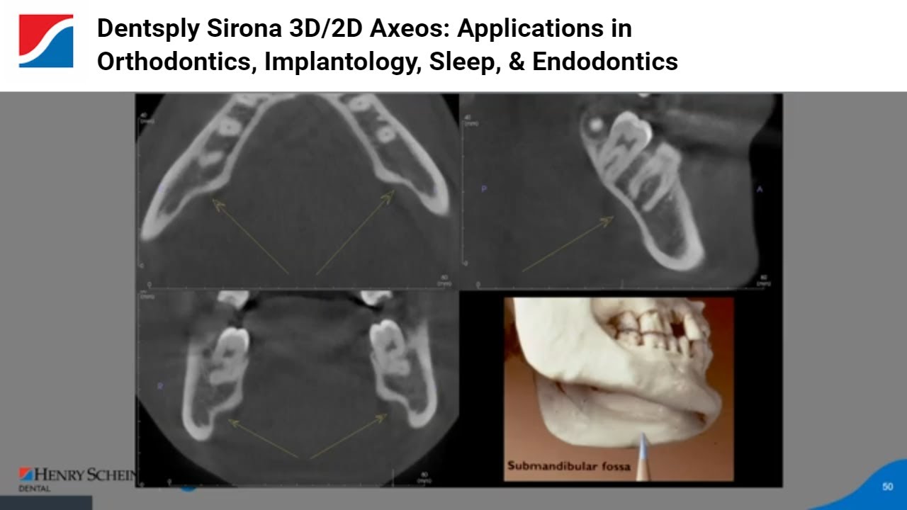 Dentsply Sirona 3D/2D Axeos: Applications in Orthodontics, Implantology, Sleep, & Endodontics
