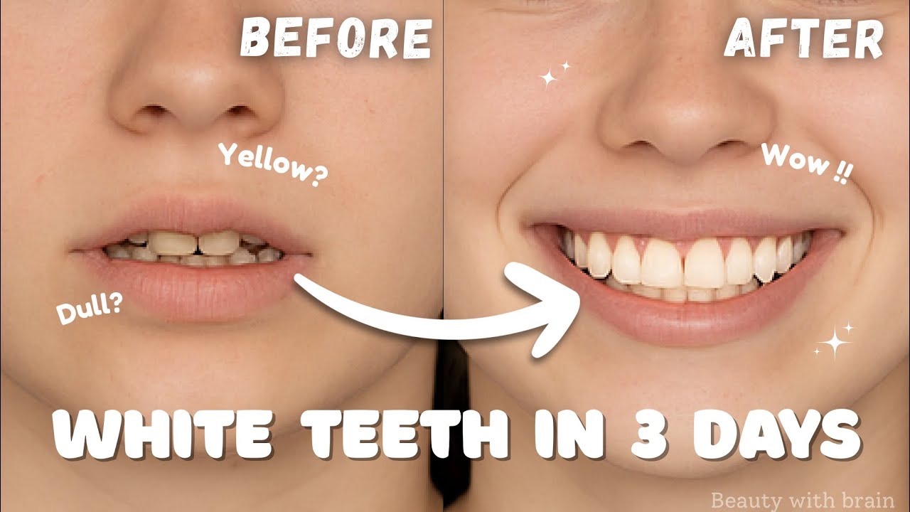 How I got WHITE TEETH in just 3 Days 🌸 || Beauty with Brain 