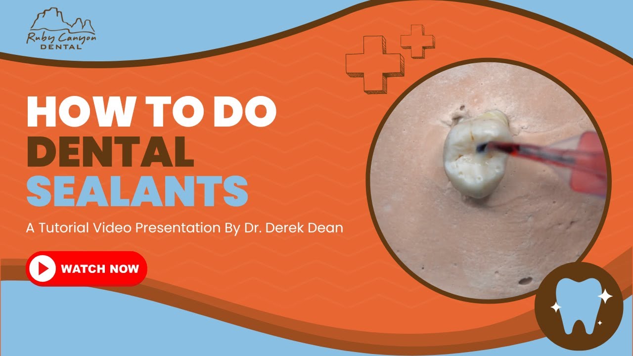 How To Do Dental Sealants