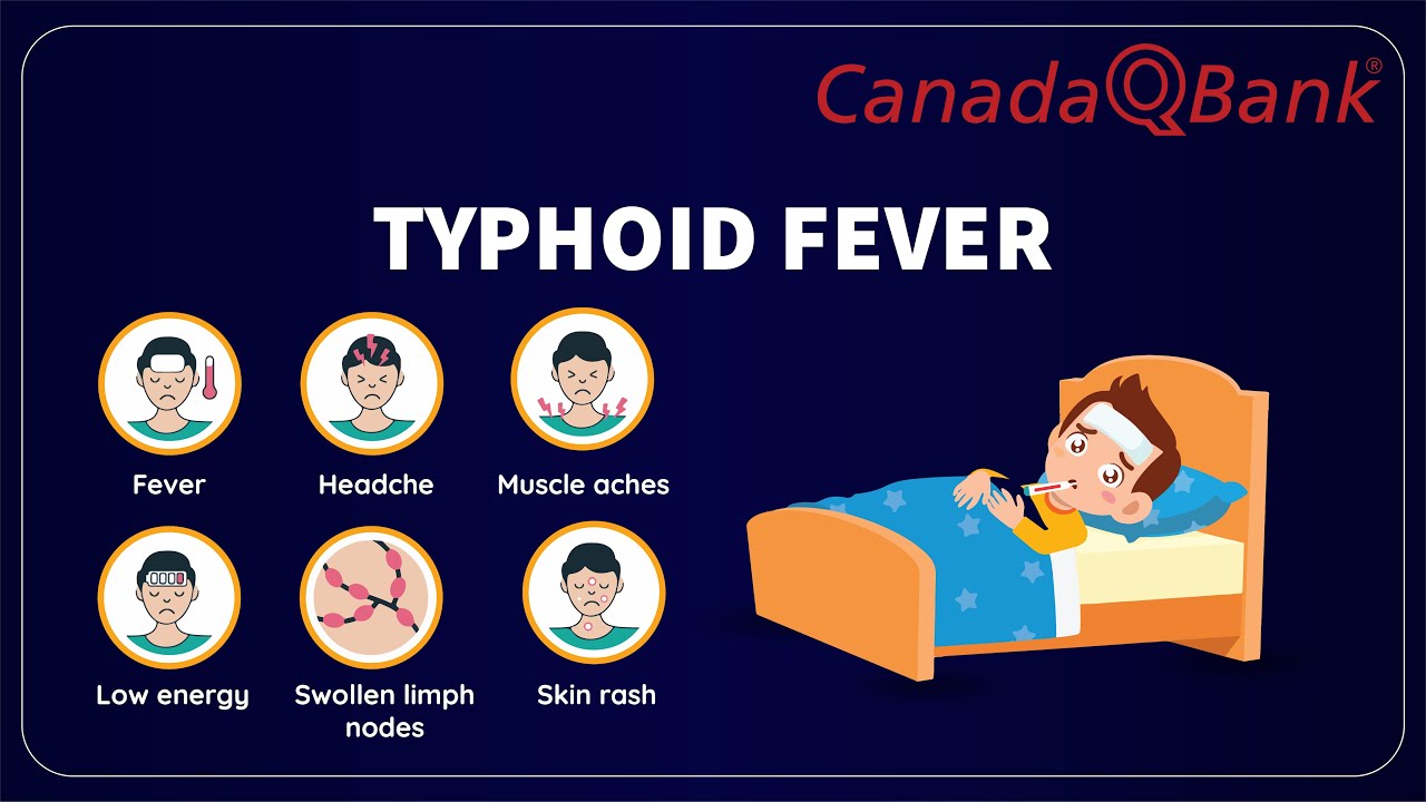 Typhoid Fever: Symptoms, Diagnosis, and Treatment | Clinical Vignettes | CanadaQBank