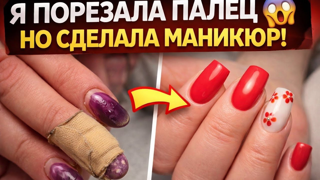 МОЖНО ЛИ ДЕЛАТЬ НОГТИ С ТРАВМОЙ?