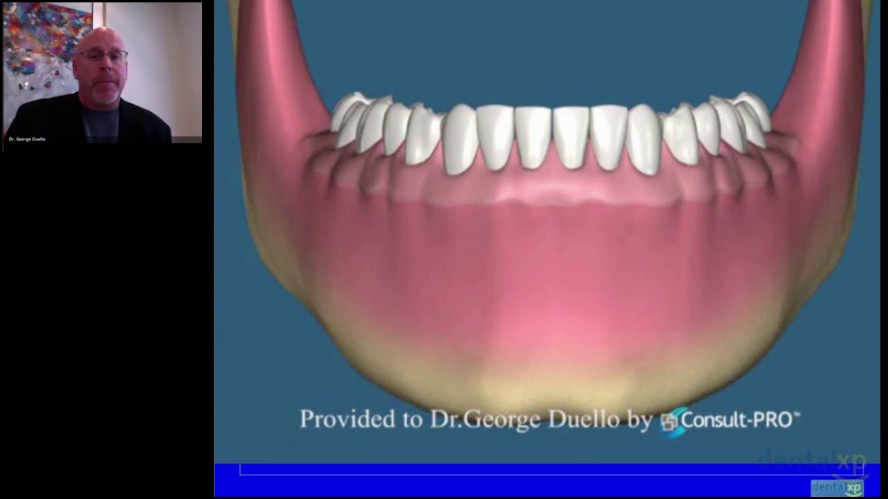 All On Four Implant Protocol  Fad or Phenomena