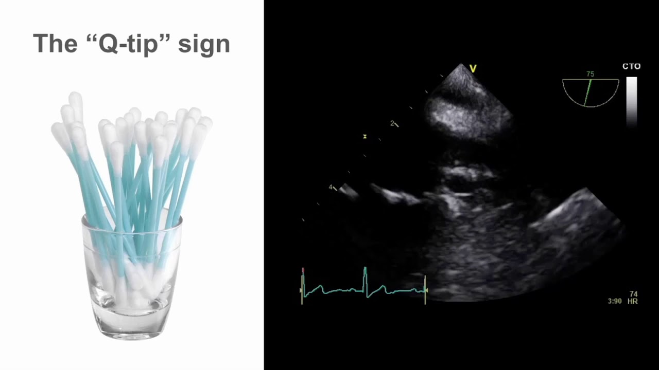 TEE Essentials: Mastering the mid-esophageal left atrial appendage view