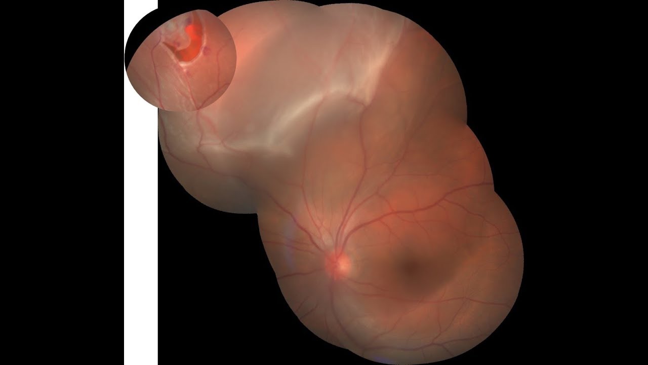 Pneumatic Retinopexy Procedure