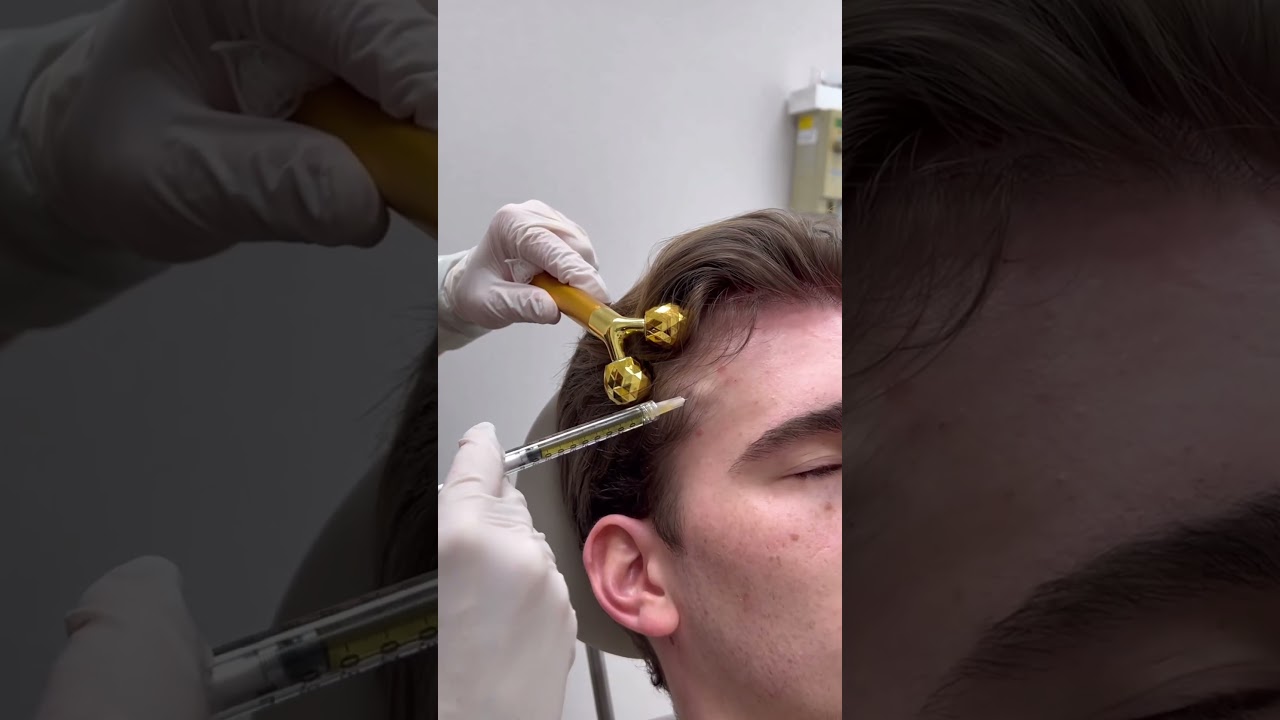PRP treatment for hair thinning