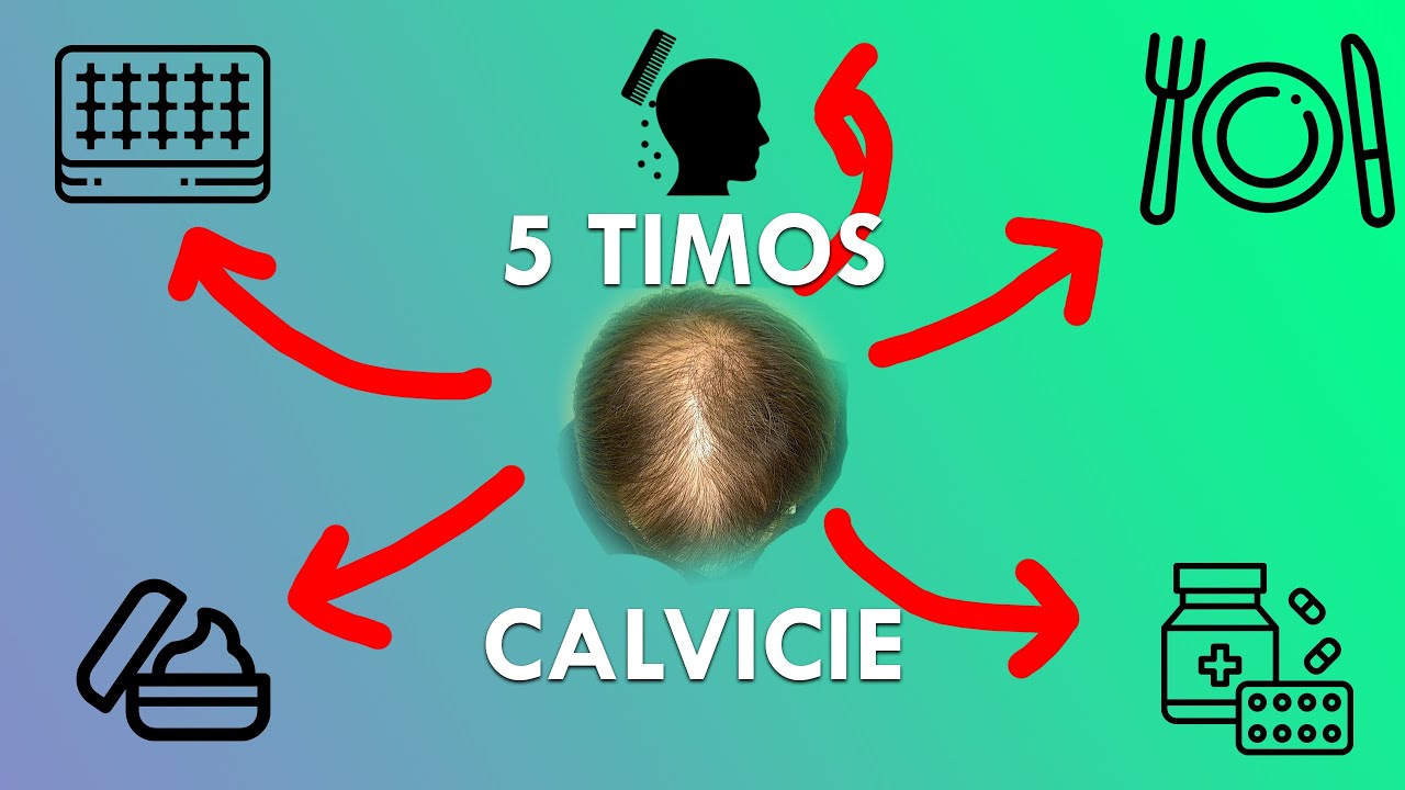 5 TIMOS CALVICIE que PUEDES CAER