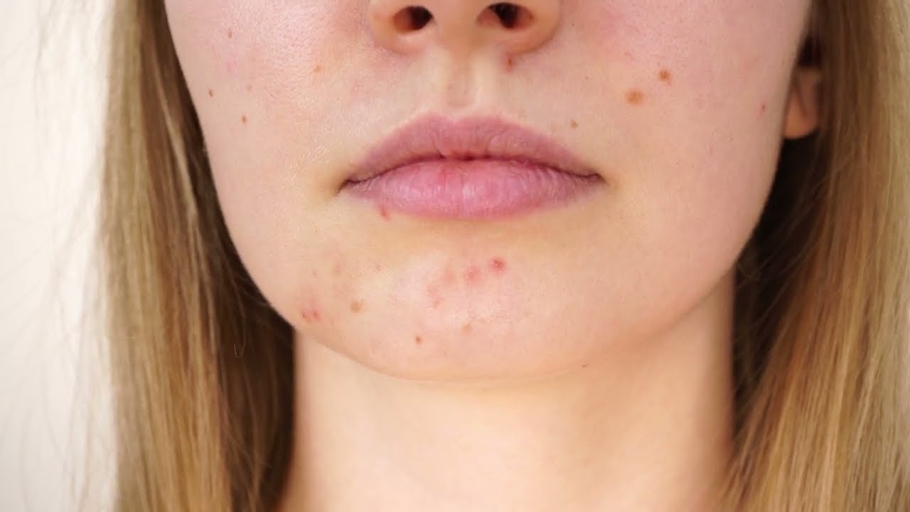 Acneea - cauze și tratament