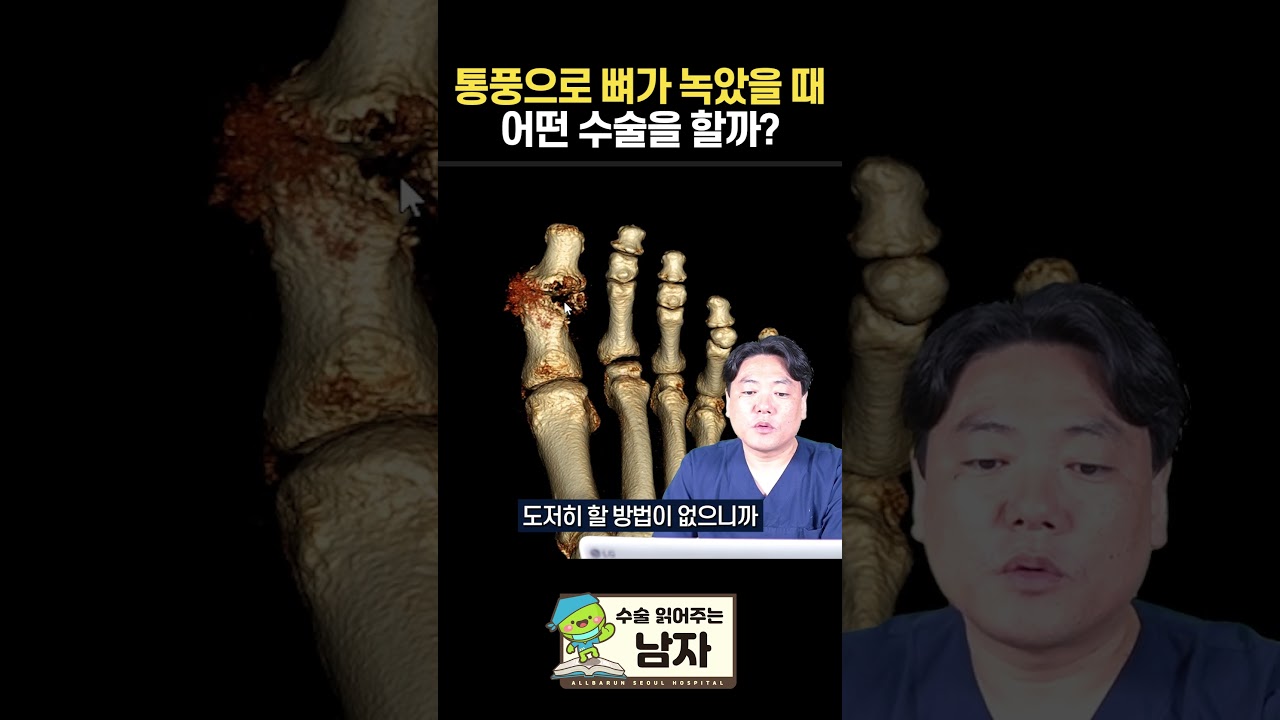 통풍으로 뼈가 녹았을 때 어떤 수술을 할까? #통풍 #올바른서울병원 #shorts