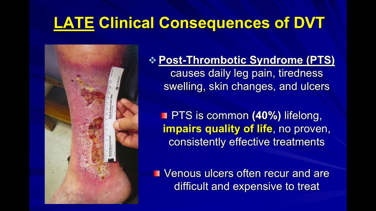 Dr. Vedanthem- Update on Post Thrombotic Syndrome