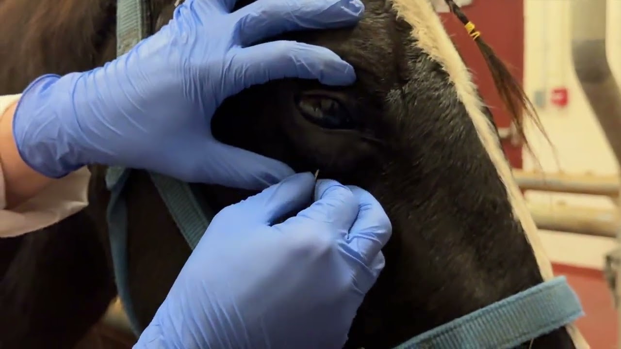 Subpalpebral Lavage System (SPL) Removal