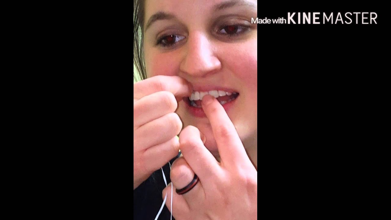 Flossing Your Fixed Retainer