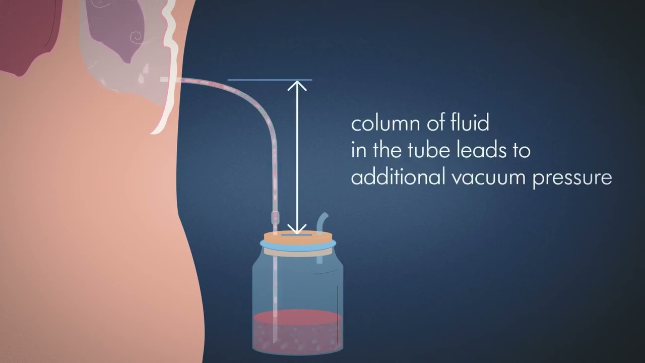 Explaining Benefits of Regulated Suction in Drainage Systems | Chest Drainage