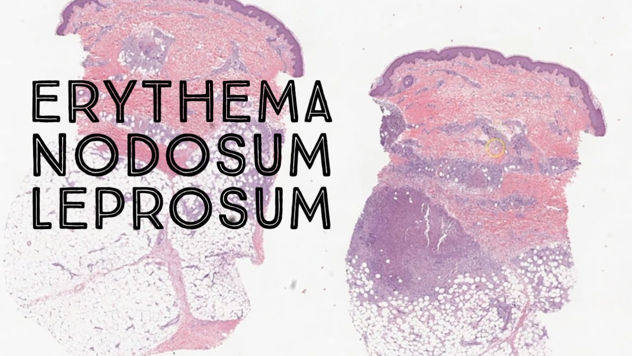 Erythema nodosum leprosum (a vasculitic reaction to leprosy) pathology dermatology dermpath