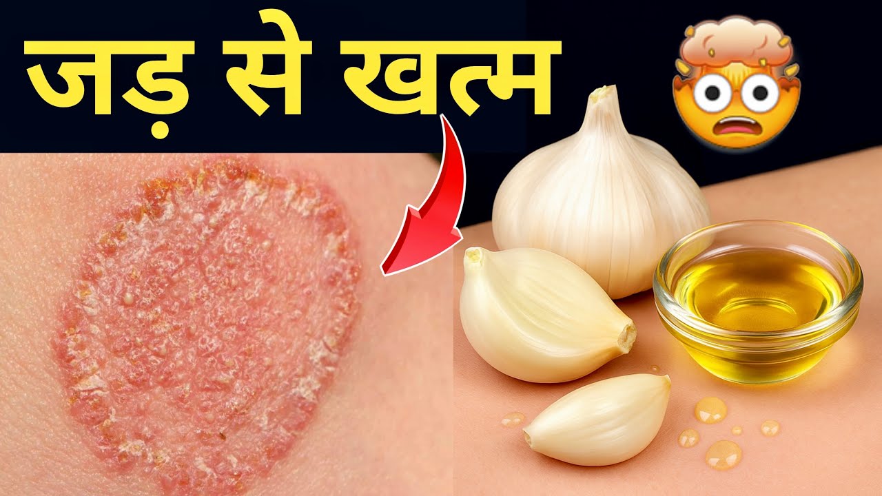 Fungal Infection Ka Ilaj 💯| दाद खुजली का पक्का इलाज