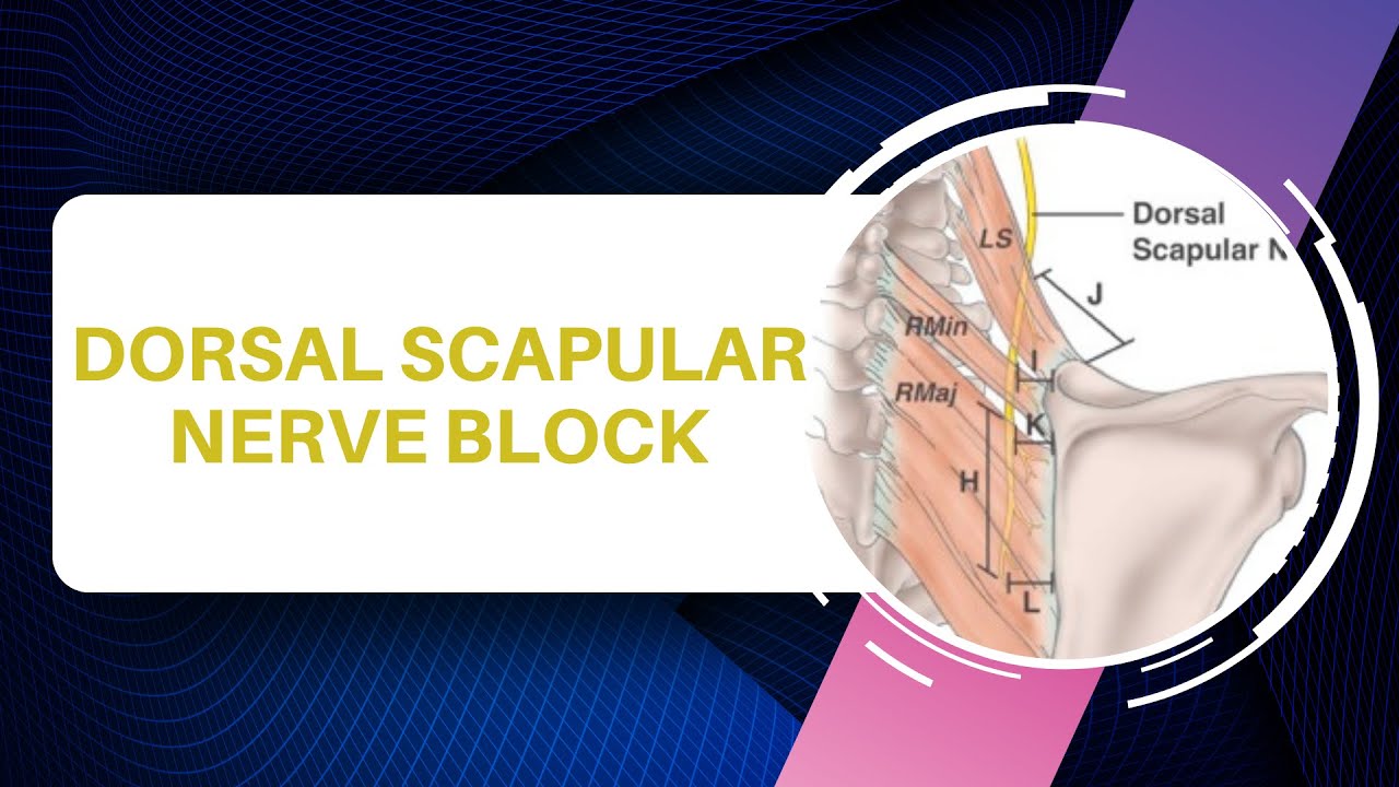 Dorsal Scapular Nerve Injection Technique