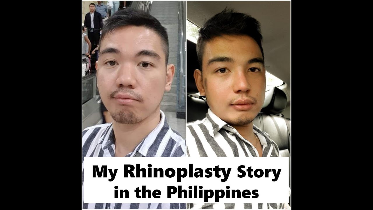 My Rhinoplasty Story in the Philippines