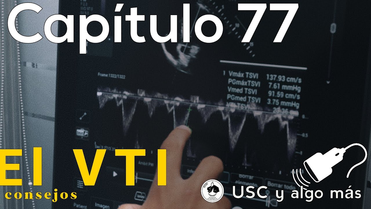 Capítulo 77: El VTI, consejos
