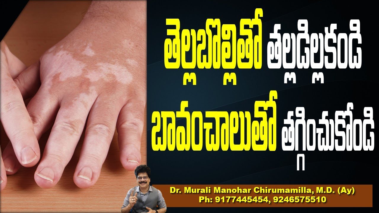 తెల్లబొల్లితో తల్లడిల్లకండి. బావంచాలుతో తగ్గించుకోండి| Best Treatment For Vitiligo #whitepatches