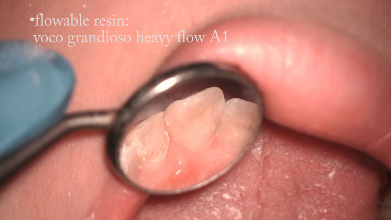 Anterior Ceramic Crown Preparation Using Extaro 300 Microscope