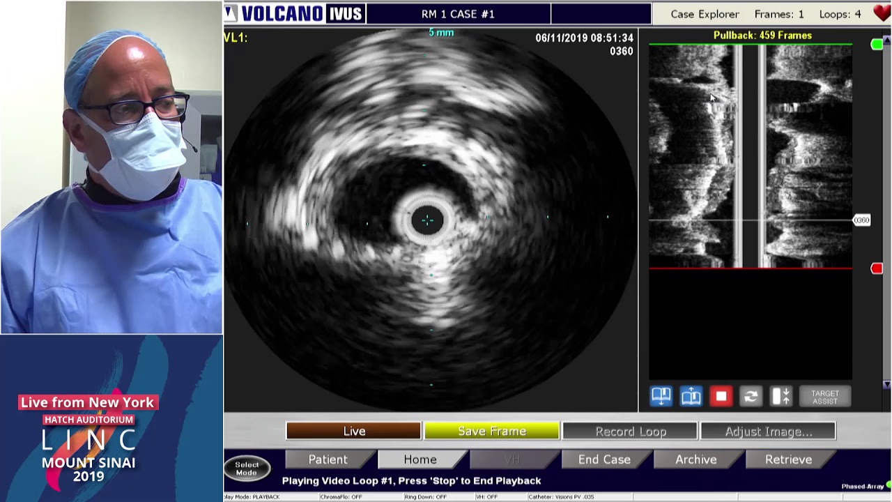 (Hatch LC#1) Left Lower Extremity Venogram, IVUS and Possible Intervention - Dr. Lookstein