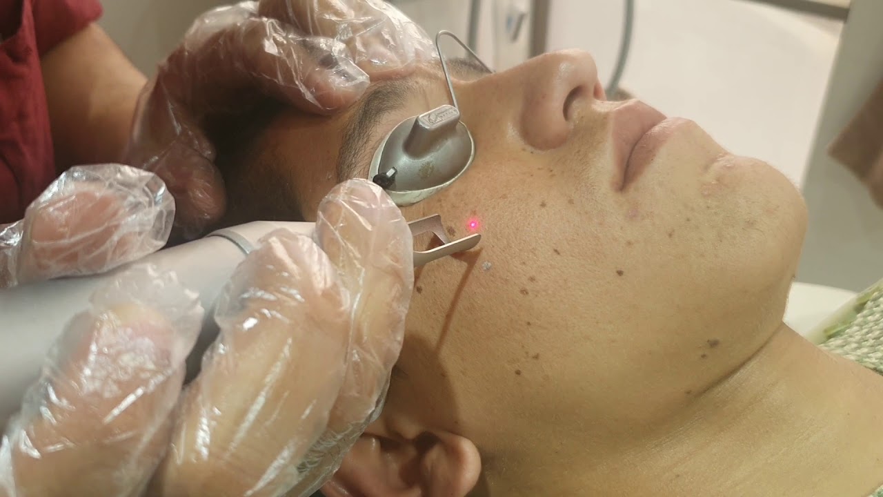 Freckles treatment with laser by Dr Syed Bilal Shams dermatologist and Cosmetologist