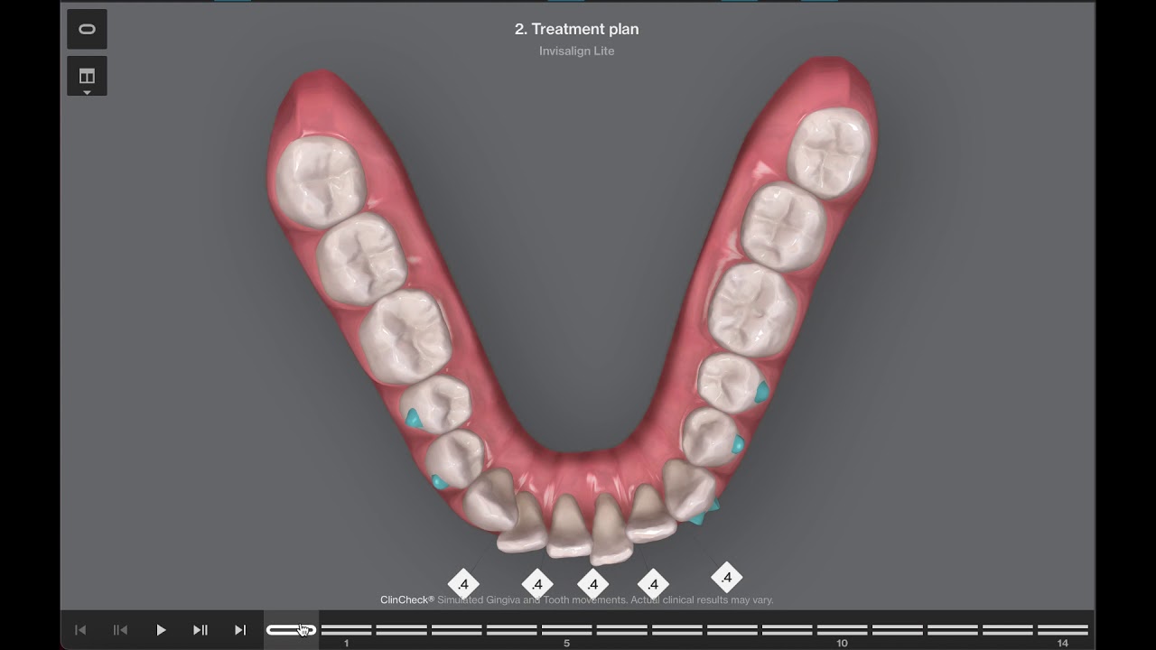 Dr Jignesh Kothari- clincheck 3: traumatic bite in relation to 21 and 31