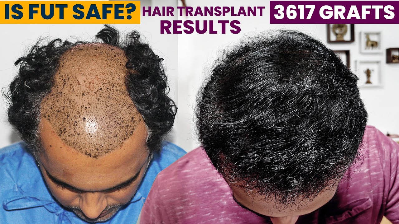 Best Hair Transplant Results & FUT Facts with Testimonial by Dr Suneet Soni
