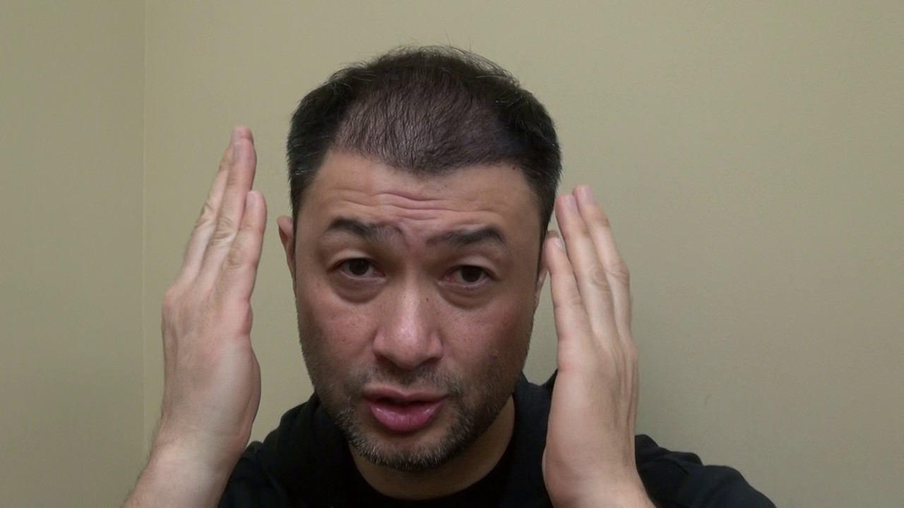 Hair Transplant 4th Month Follow Up Restoration Surgery Progress Dr. Diep http://www.mhtaclinic.com