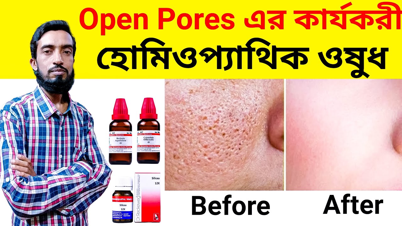 ওপেন পোরস এর হোমিওপ্যাথিক ওষুধ| How To Cure Open Pores On Face | Homeopathic Medicine For Open Pores