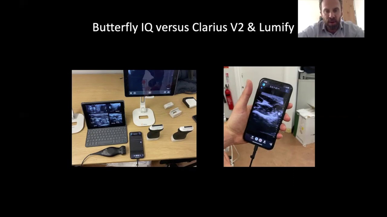 Butterfly IQ Review SMUG Video
