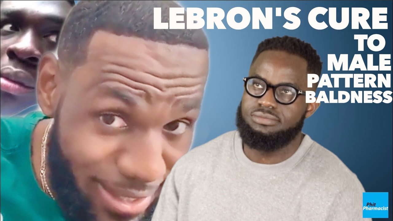 LEBRON'S CURE TO MALE PATTERN BALDNESS: HOW TO TREAT