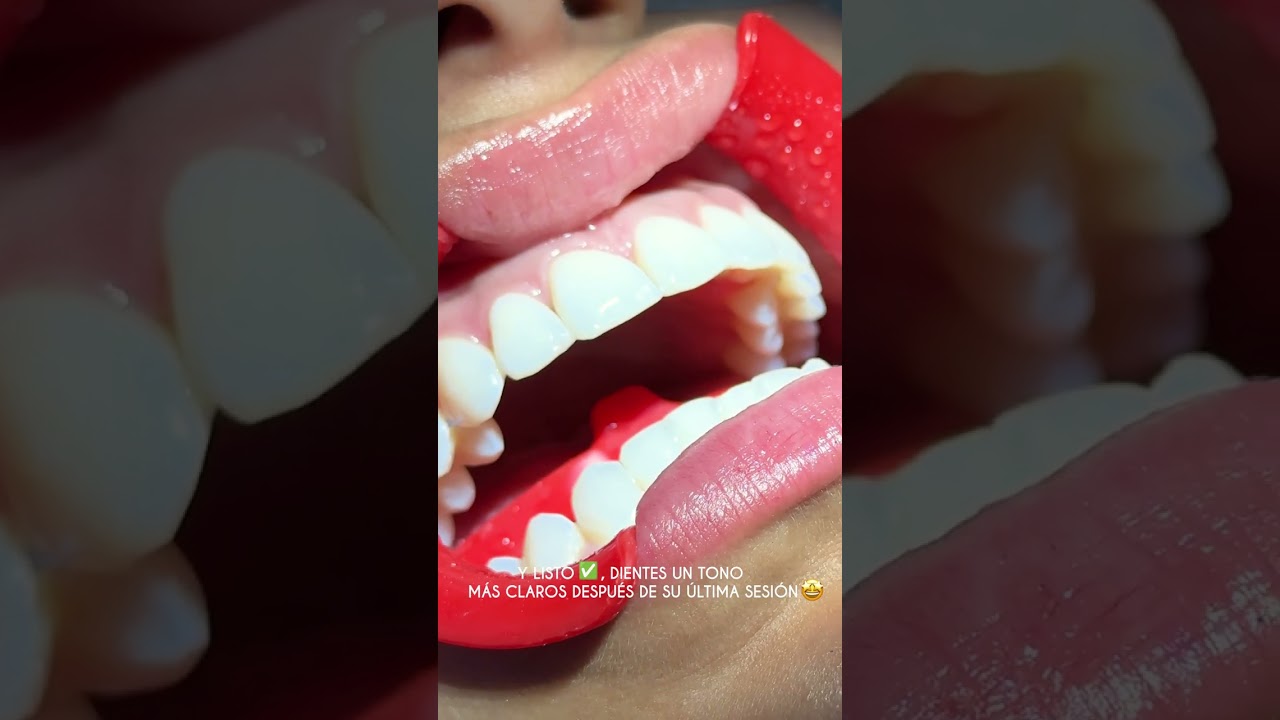 Así se hace un blanqueamiento dental 🦷