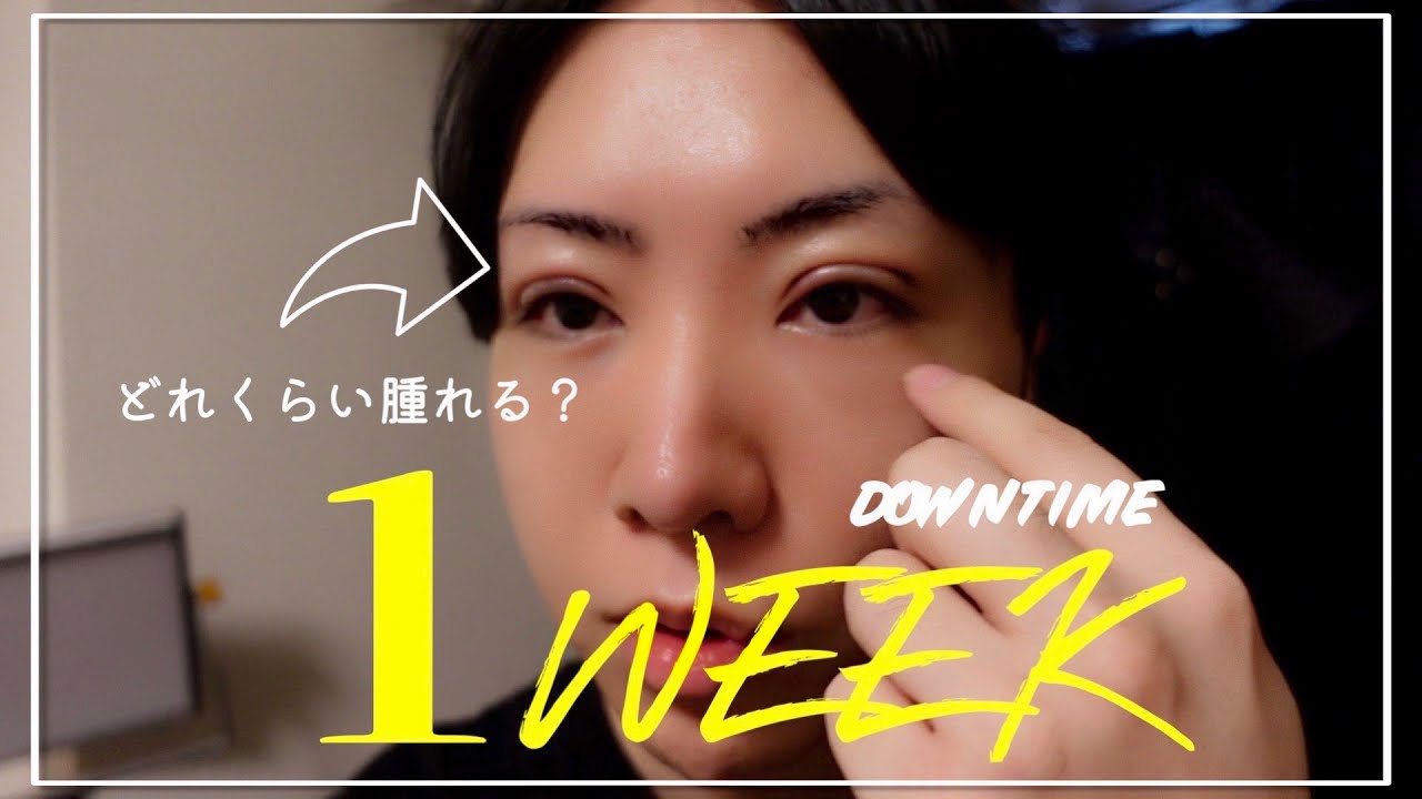 【二重修正】ダウンタイム1週目抜糸までを撮影したら大変すぎた