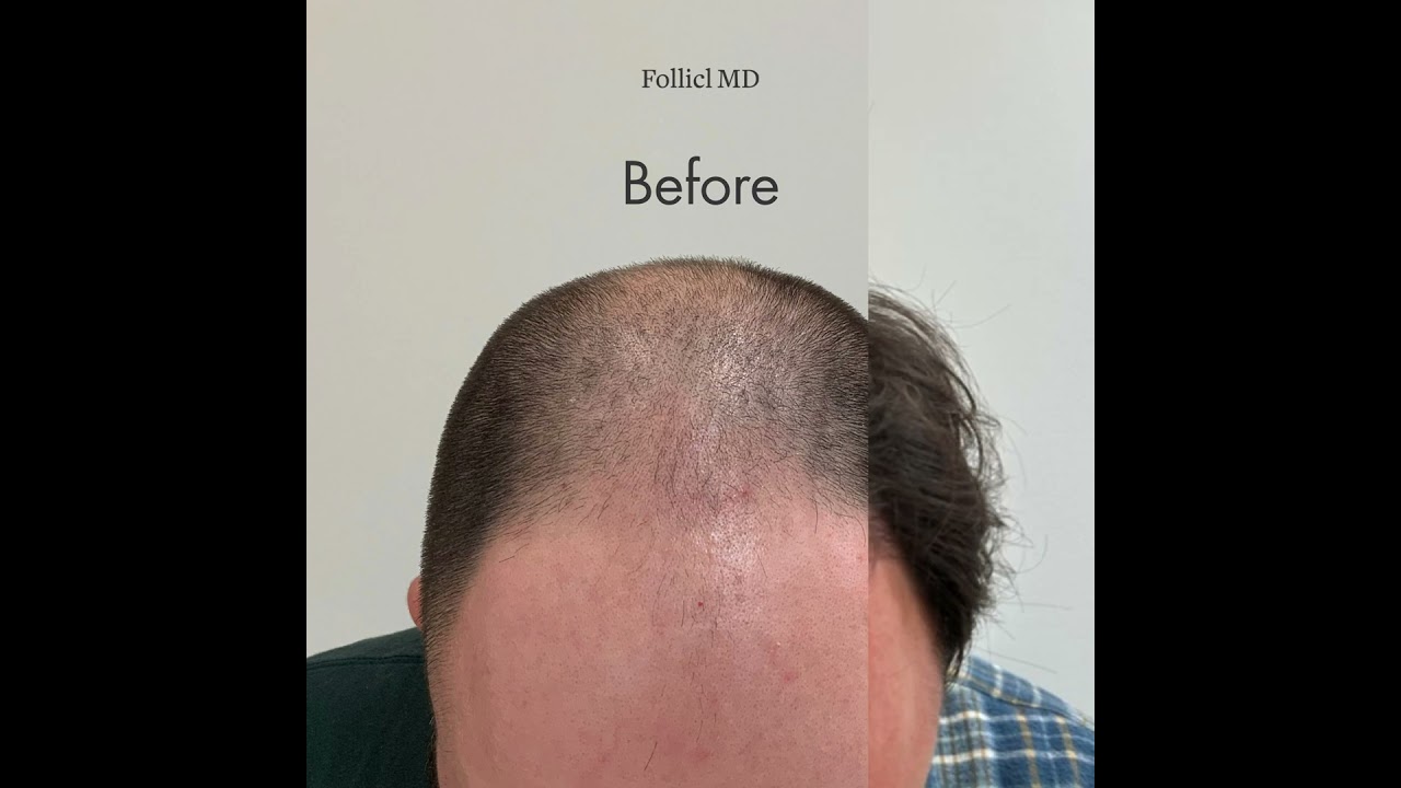 Before & After Hair Transplant for Overall Lack of Density