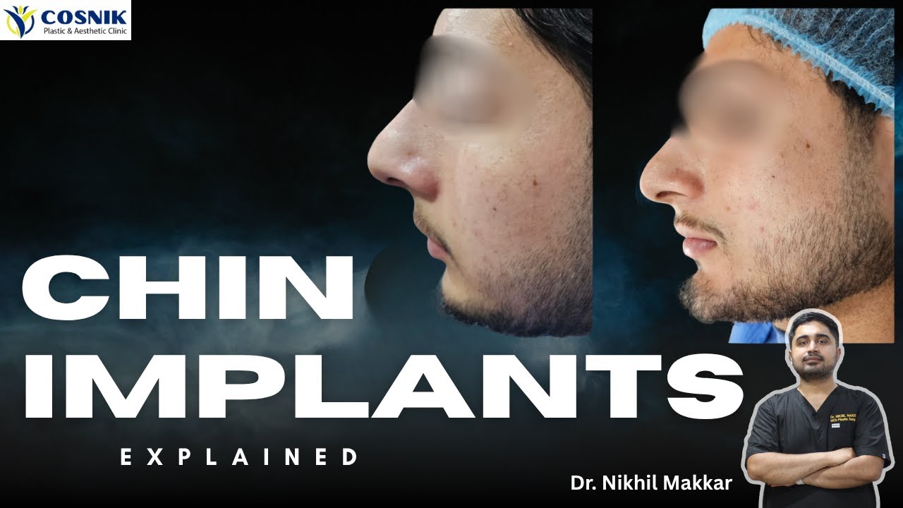 Chin implant : Game Changer in Facial Aesthetics | Dr. Nikhil Makkar | Cosnik Clinic Mohali