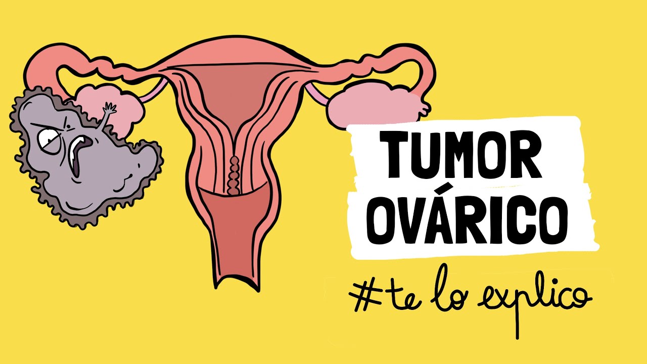Quiz&aacute;s te est&aacute;s MURIENDO y no lo sabes: TUMOR OV&Aacute;RICO | #TELOEXPLICO