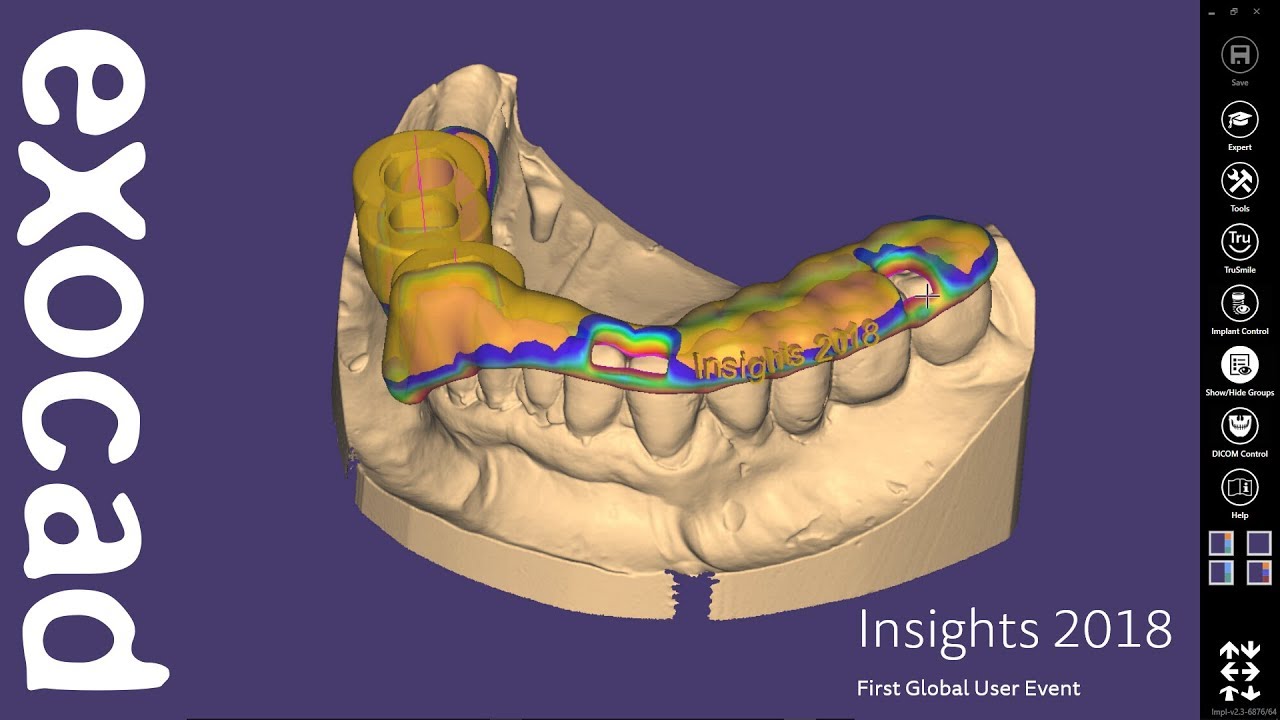 INSIGHTS 2018: exoplan Case Demonstration - Planning of implants and design of a surgical guide