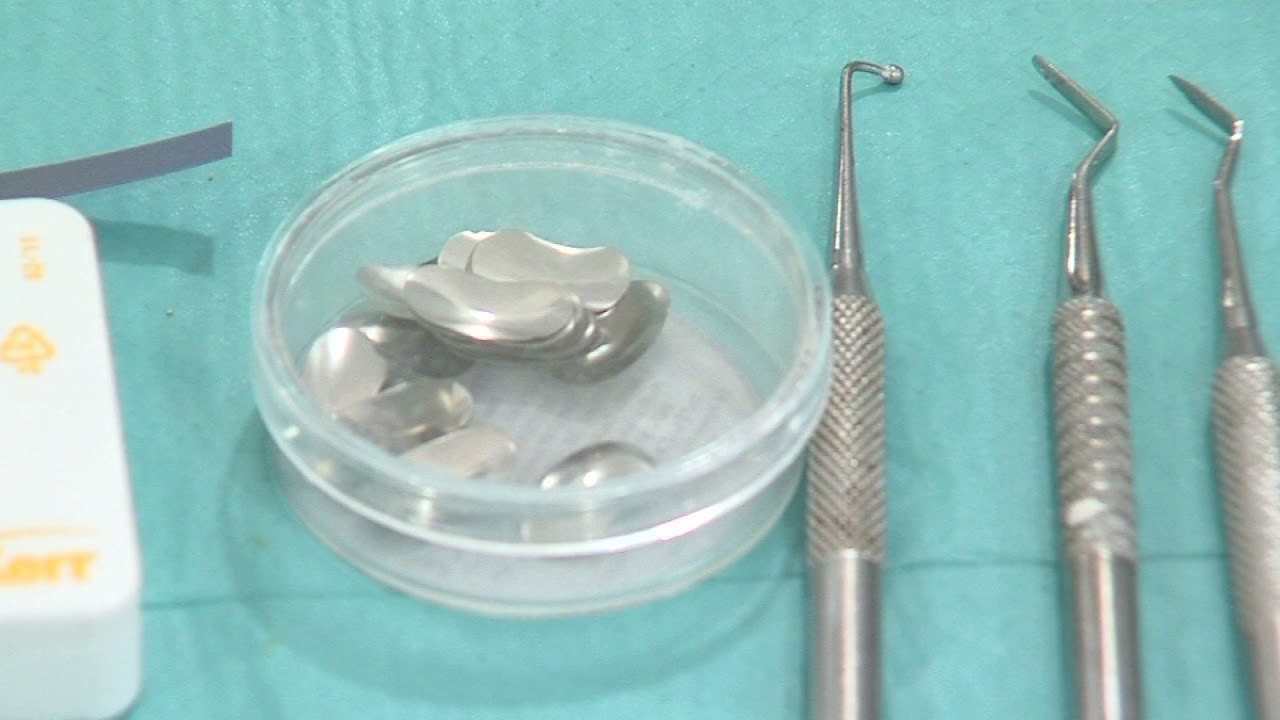 OPERATORIA DENTAL Y ENDODONCIA: TÉCNICAS Y MATERIALES_8. COMPOSITE: CAVIDAD DE CLASE II.