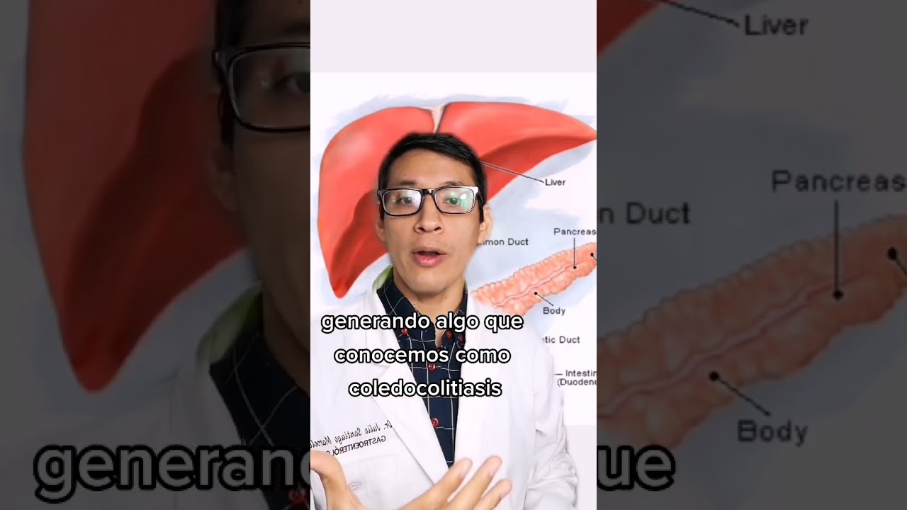 Riesgos de tener c&aacute;lculos en la ves&iacute;cula