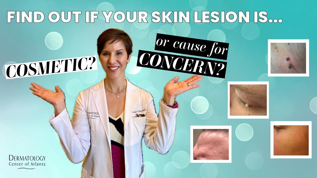 Common Skin Growths: Cosmetic or Cause for Concern?