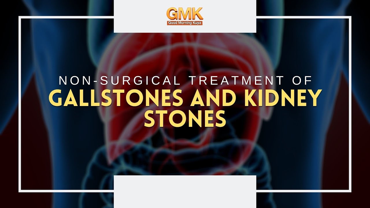 Non-surgical treatment of Gall stones and Kidney Stones (PART 2) | Usapang Pangkalusugan
