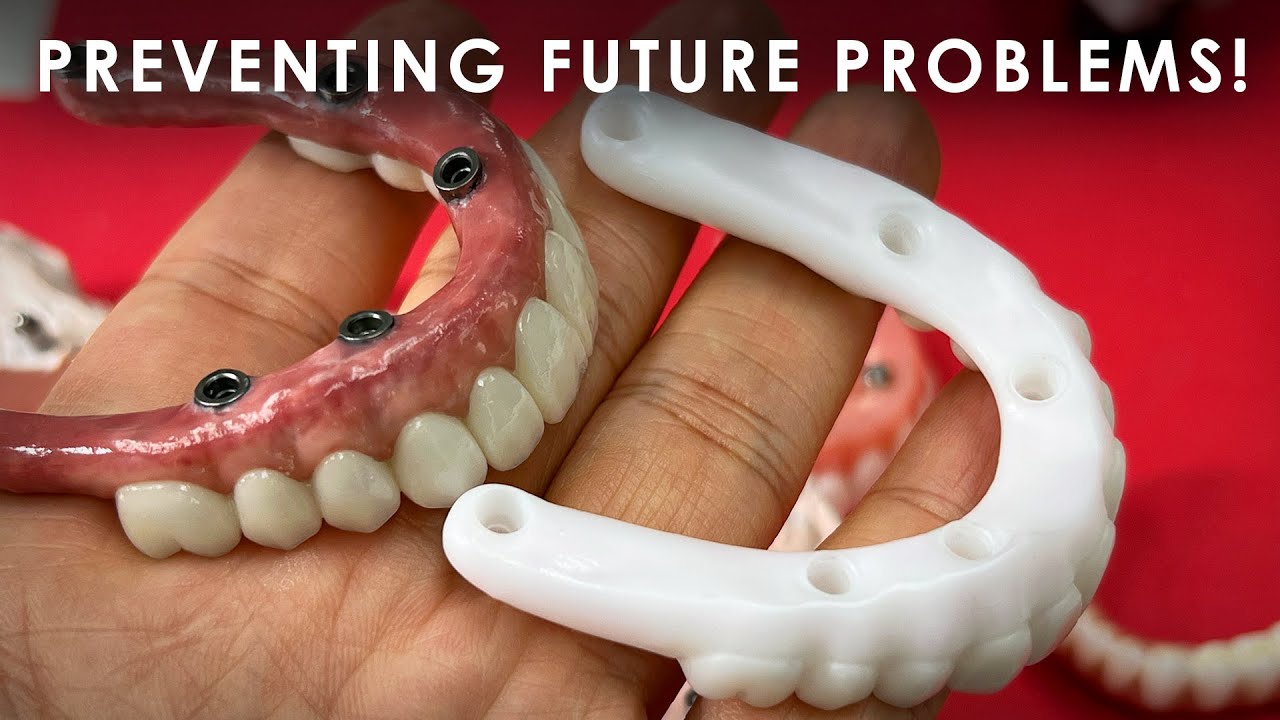 Preventing Future Problems with Full Mouth Implants