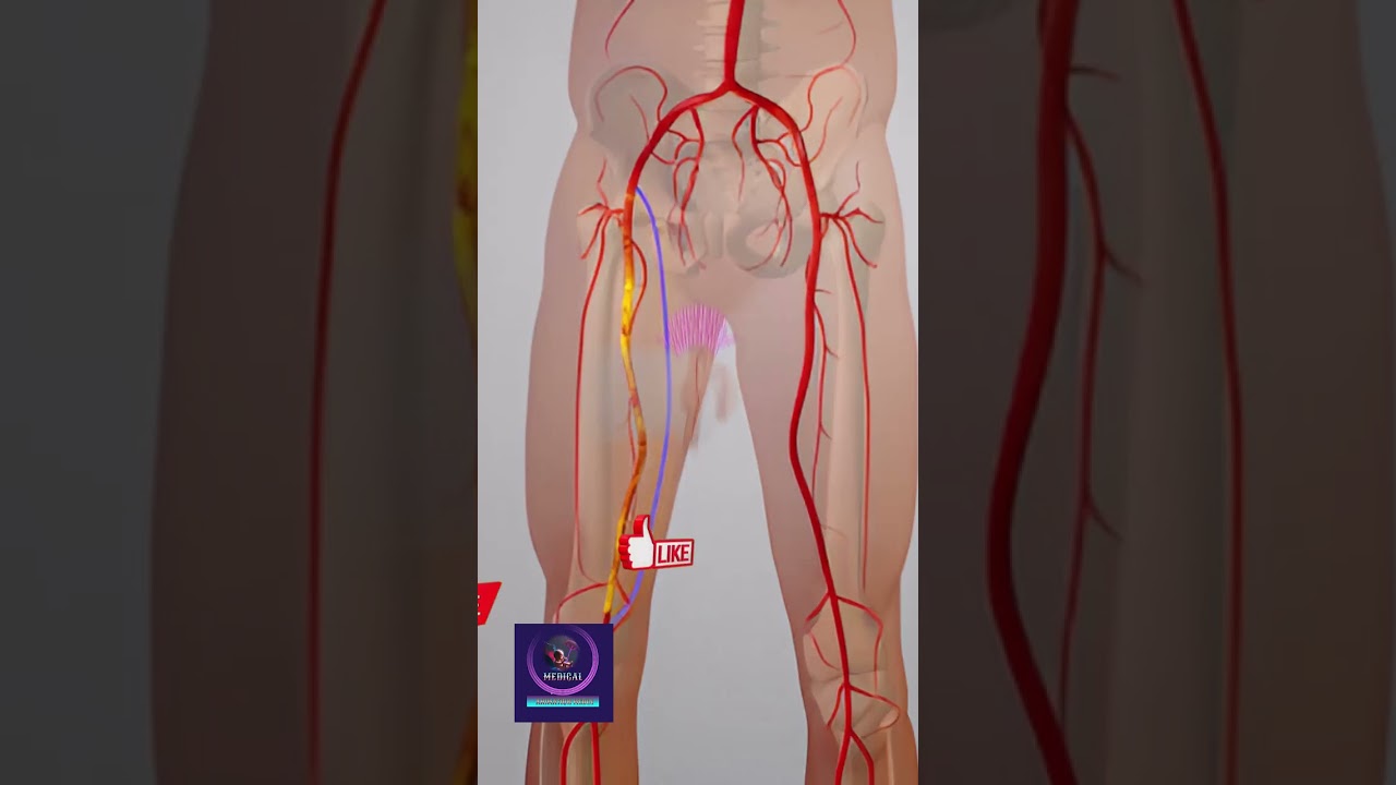 Peripheral Artery Bypass Surgery